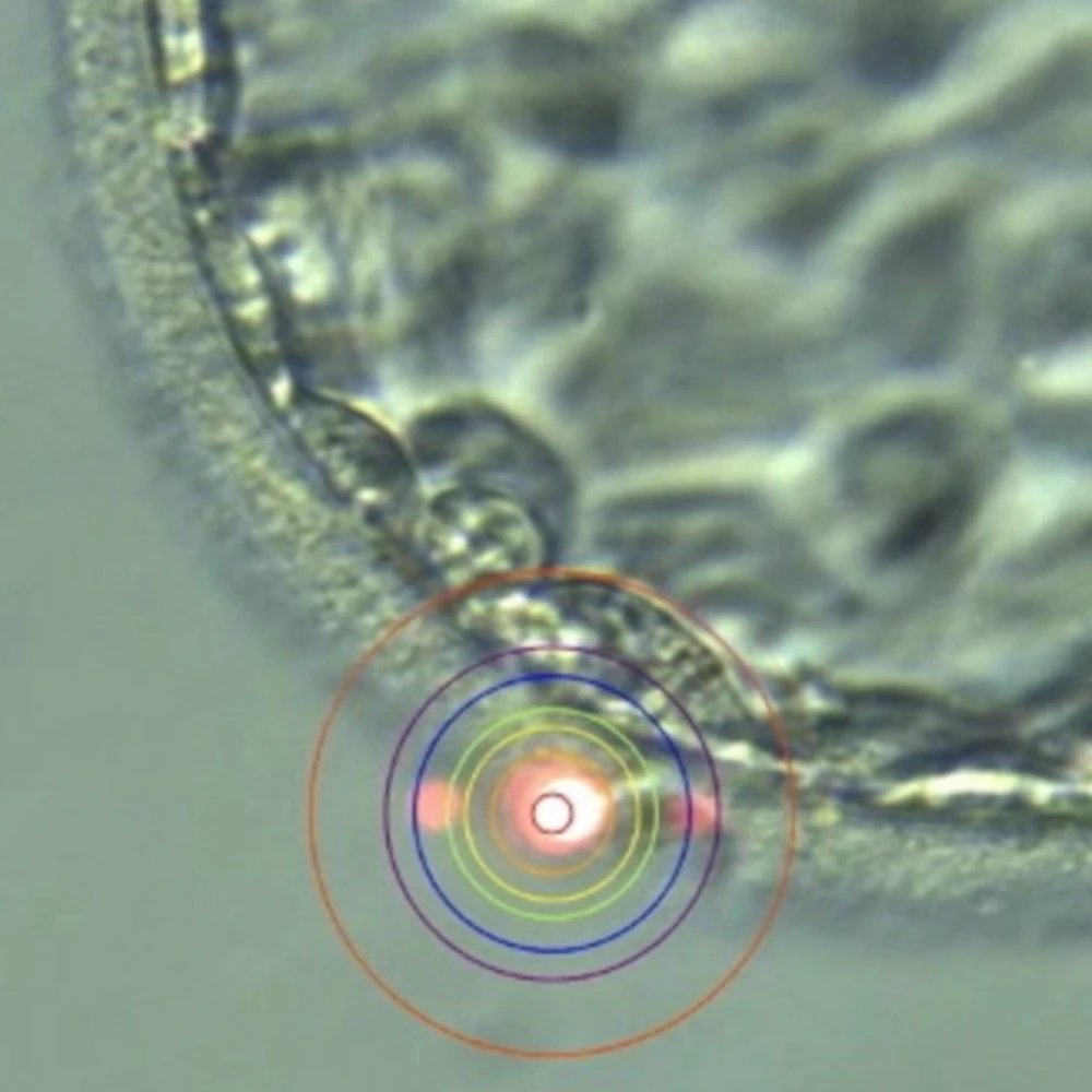 Laser Assisted Hatching technology at Sunfert using precision laser system to help embryos hatch and improve implantation rates in selected IVF patients