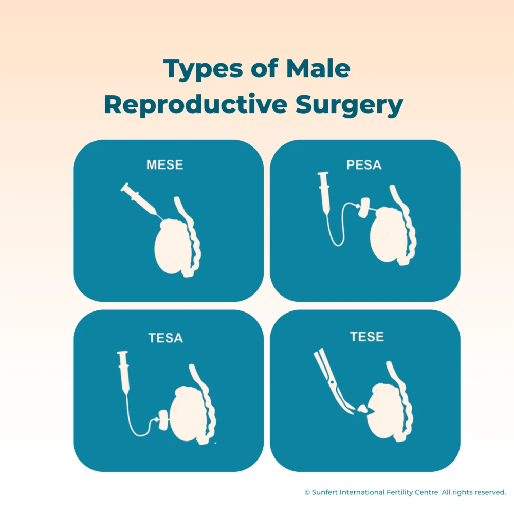 Sunfert types of male reproductive surgery including MESA, PESA, TESA, and TESE for sperm retrieval and fertility treatment