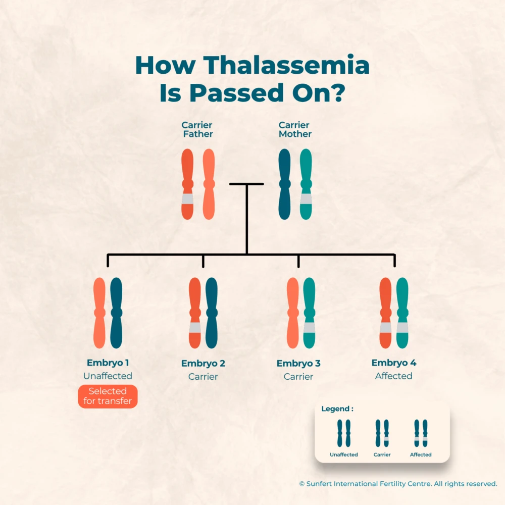 An infographic illustrating how thalassemia is passed on from a carrier father and carrier mother, showing 4 possible embryo outcomes: Embryo 1 unaffected (selected for transfer), Embryo 2 carrier, Embryo 3 carrier, and Embryo 4 affected.